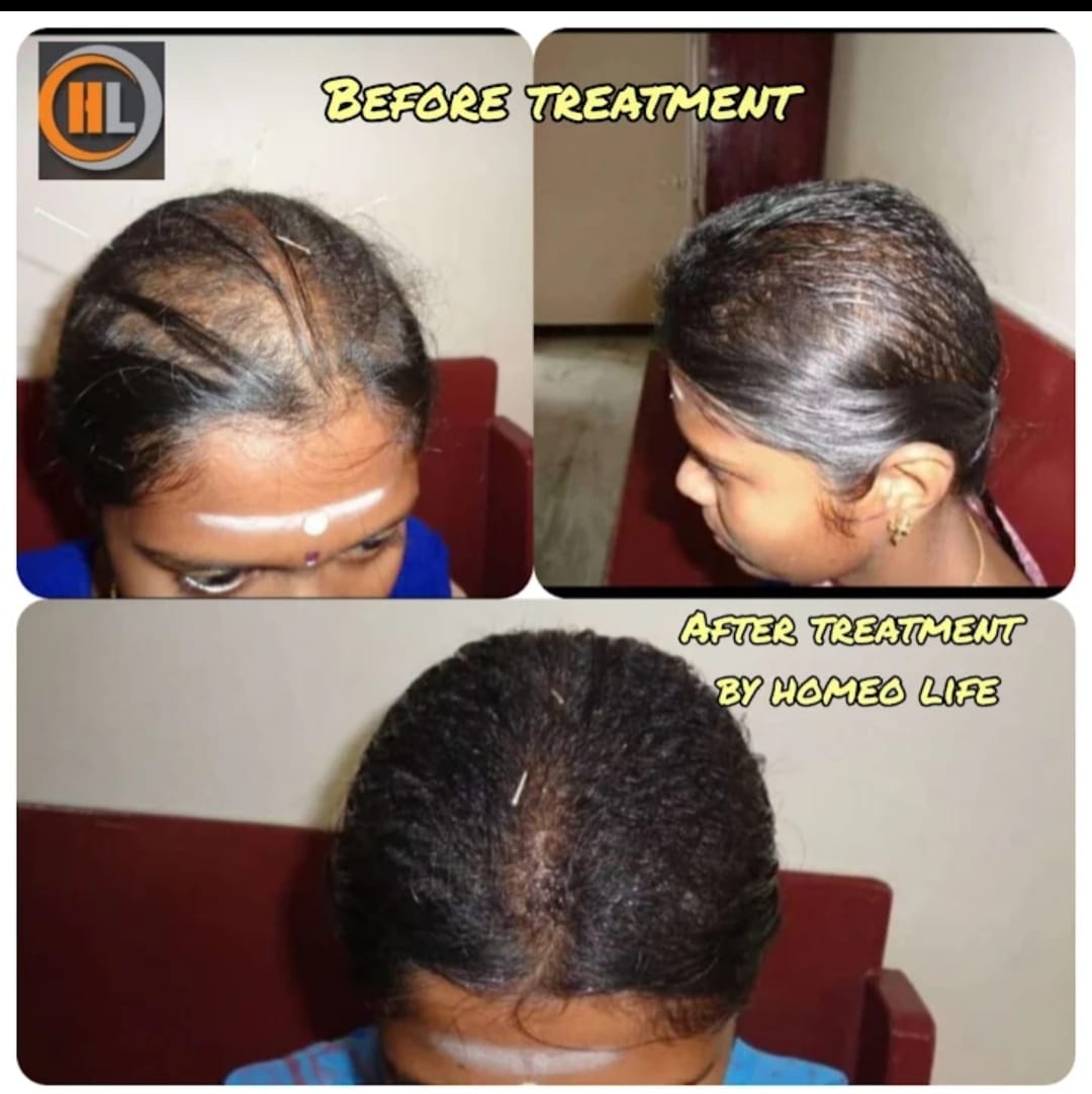Hair regrowth — before and after — The Homeo Life Clinic