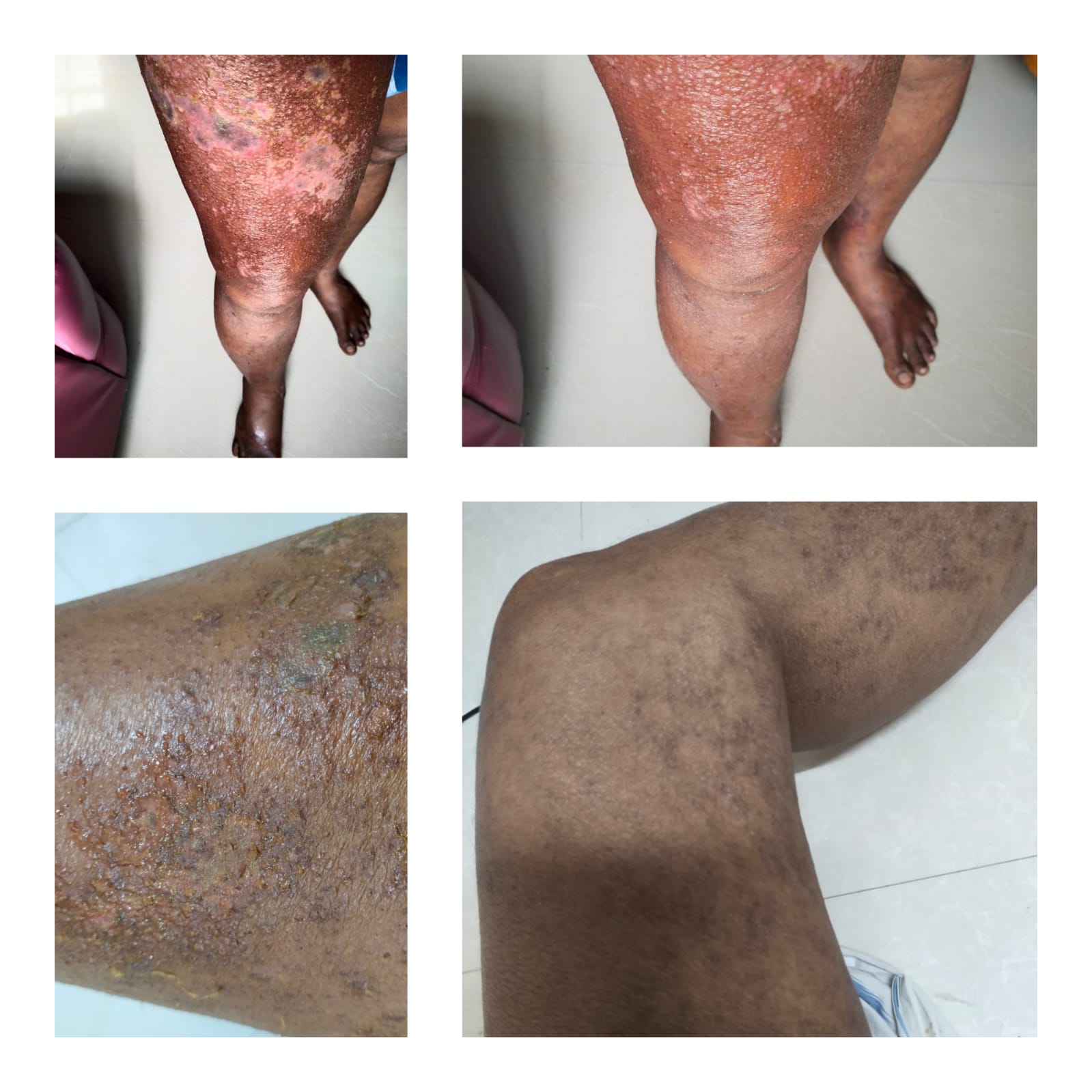 Skin condition — progressive recovery — The Homeo Life Clinic