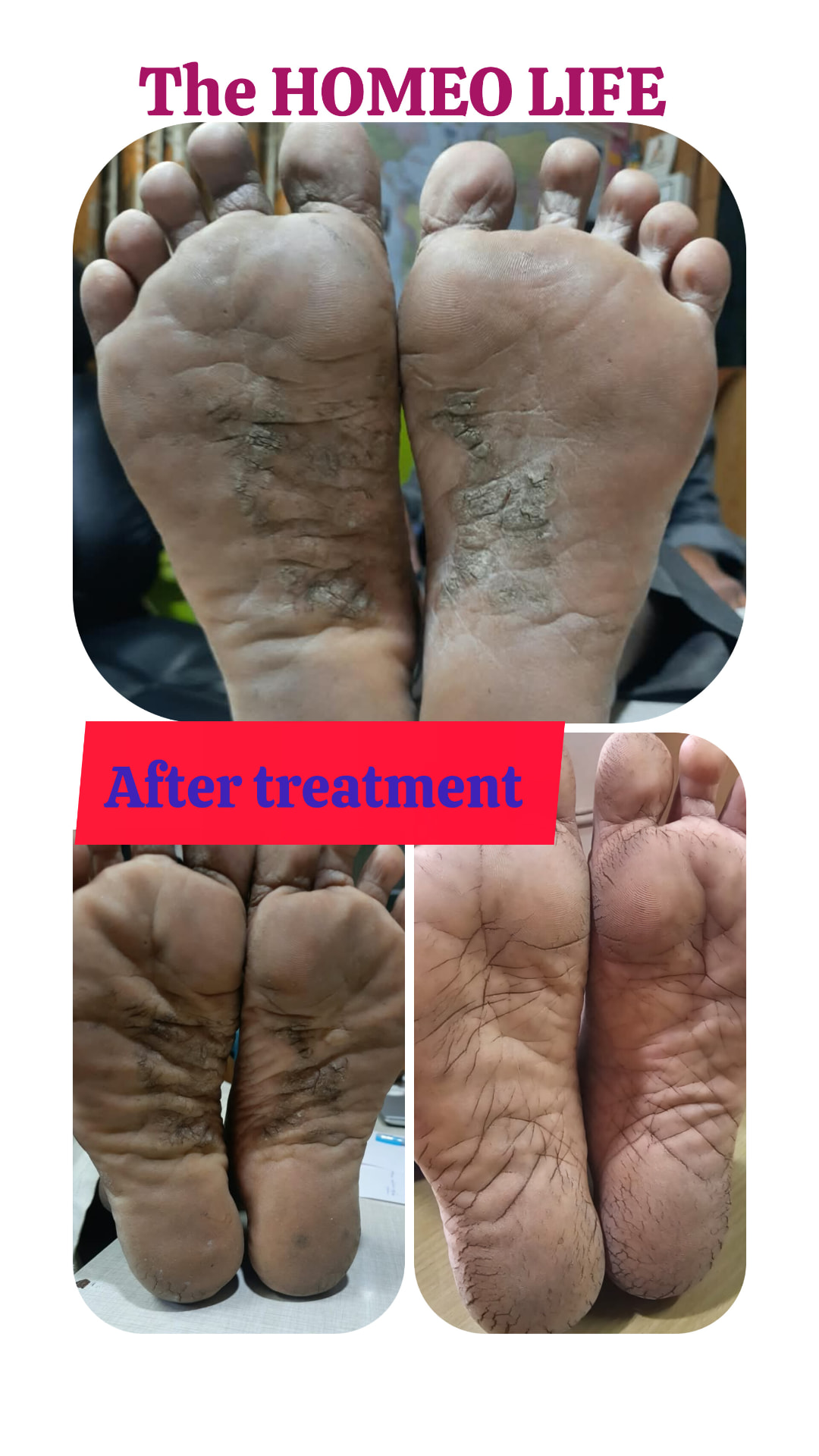 Foot skin condition — before and after — The Homeo Life Clinic