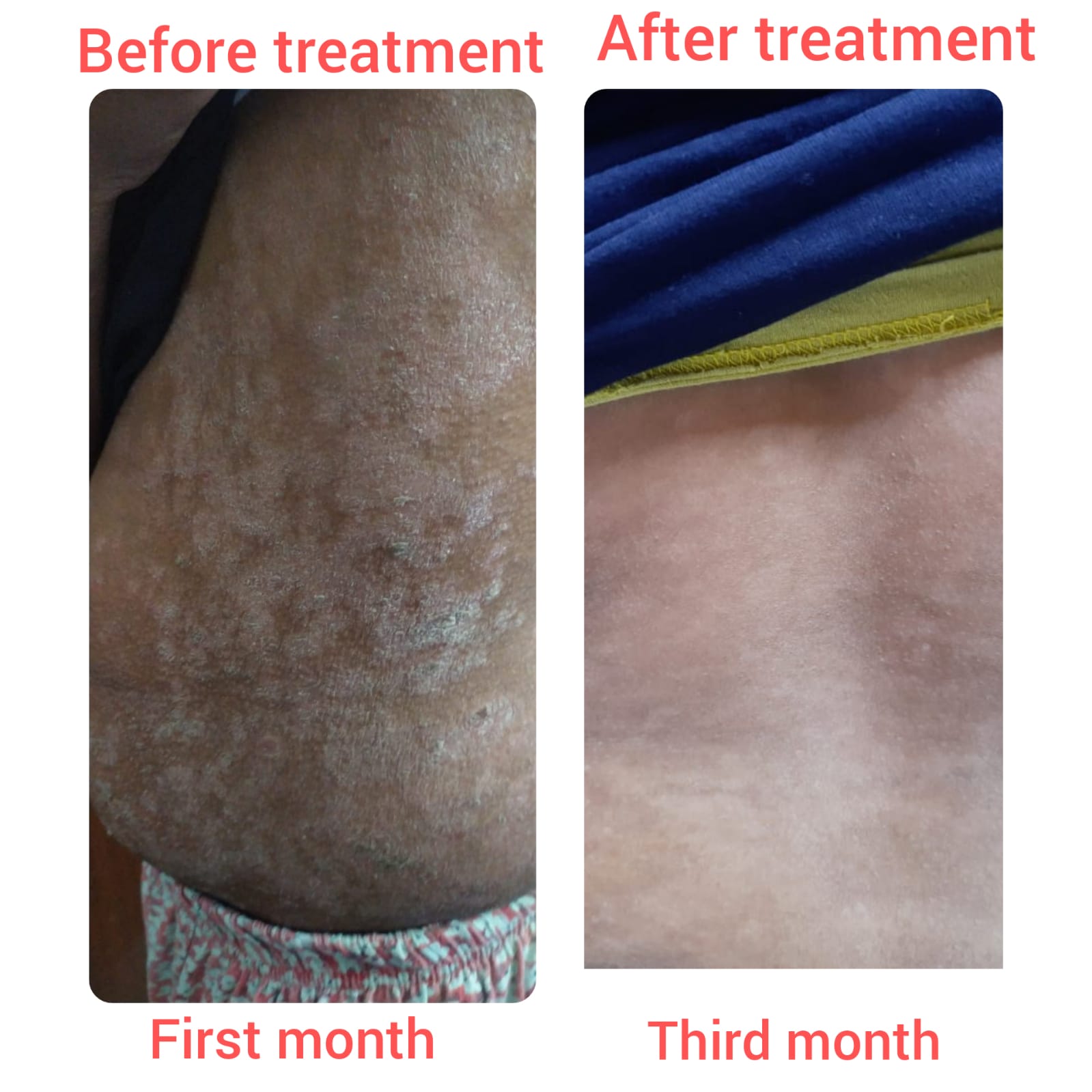 Before treatment and third month — The Homeo Life Clinic