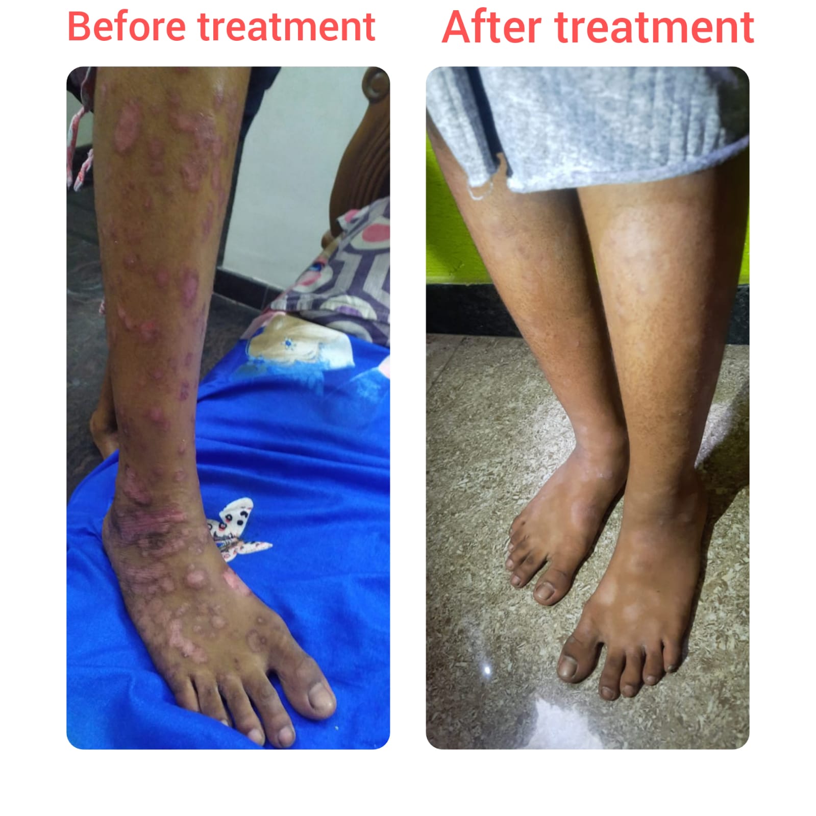 Before and after treatment — The Homeo Life Clinic