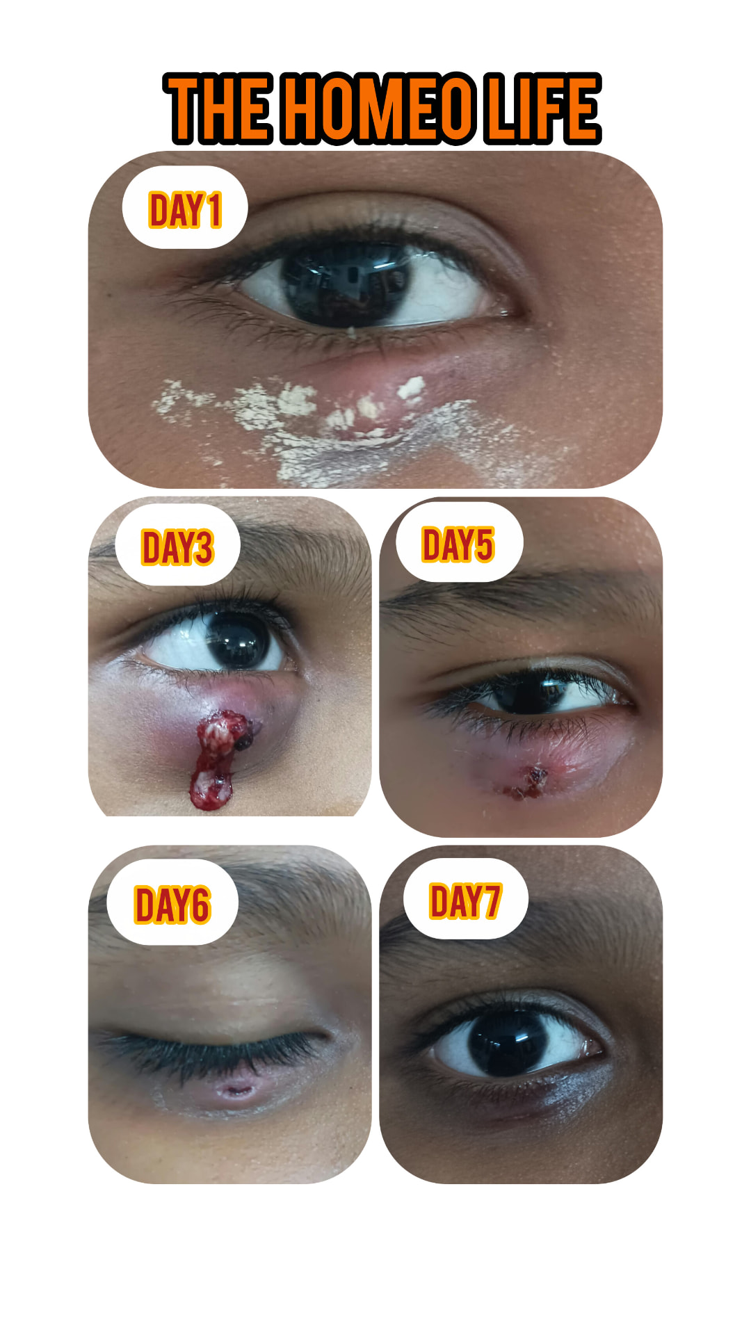 Day 1 to Day 7 recovery — The Homeo Life Clinic