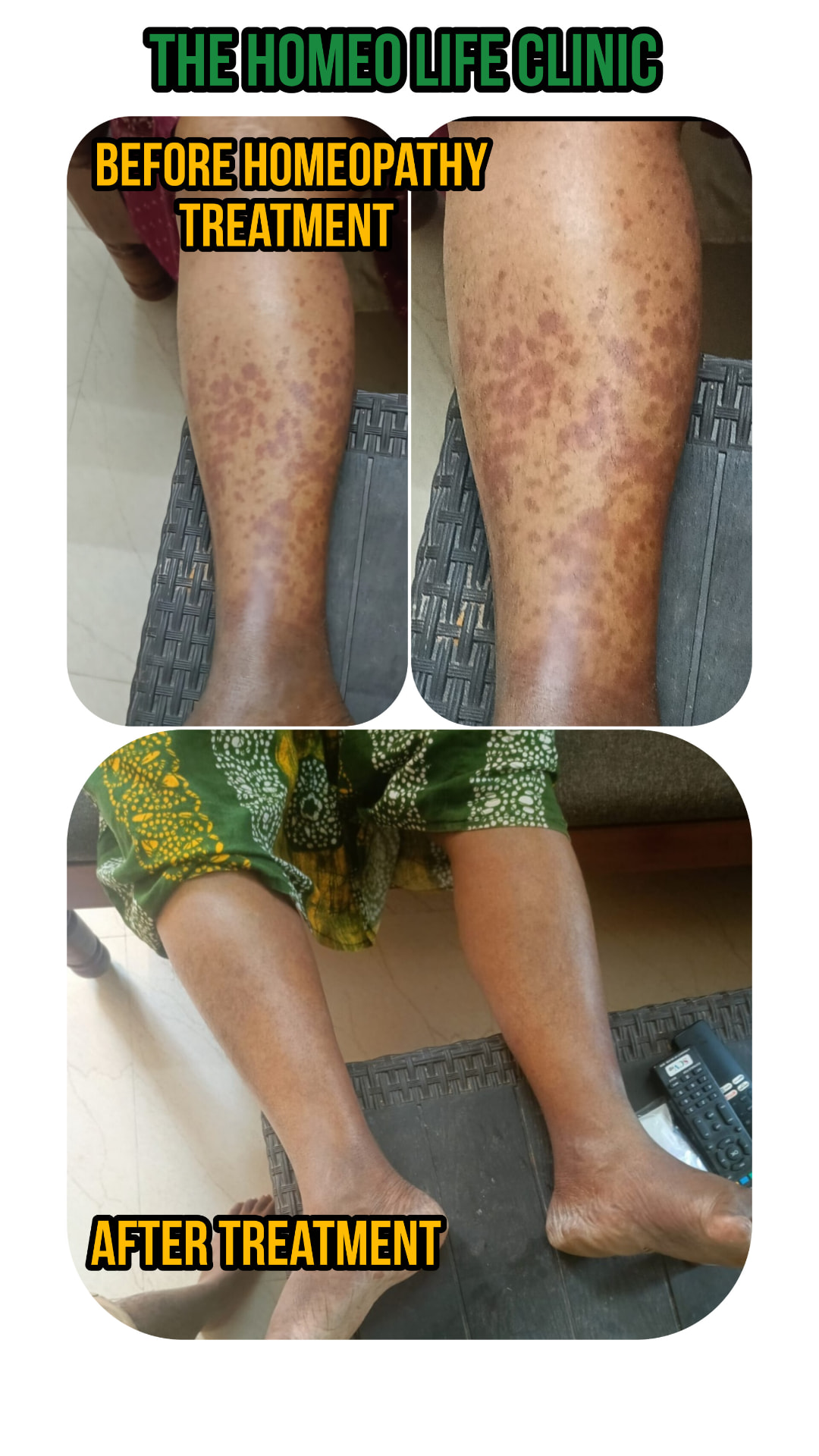 Leg skin condition — before and after — The Homeo Life Clinic
